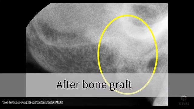 Ora Aid/ Socket Graft Bio Oss 200921 смотреть онлайн