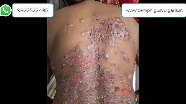 Pemphigus Vulgaris A Makeover Journey – 59 смотреть онлайн