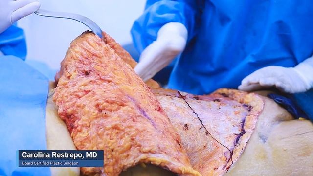 Nice Tummy Tuck, 360 Liposuction and Brazilian Butt Lift, combination procedure. смотреть онлайн