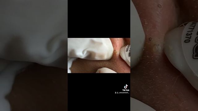 #асмр #acne #acnetreatment #прыщи #asmracne #угри #давитьпрыщи смотреть онлайн