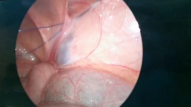 Inguinal hernia in child. laparoscopic Hernia смотреть онлайн