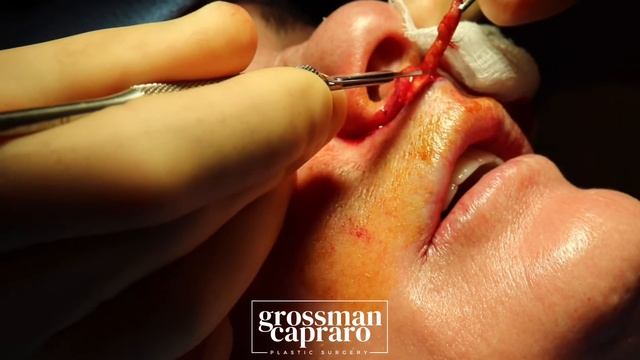 Surgical Lip Lift смотреть онлайн