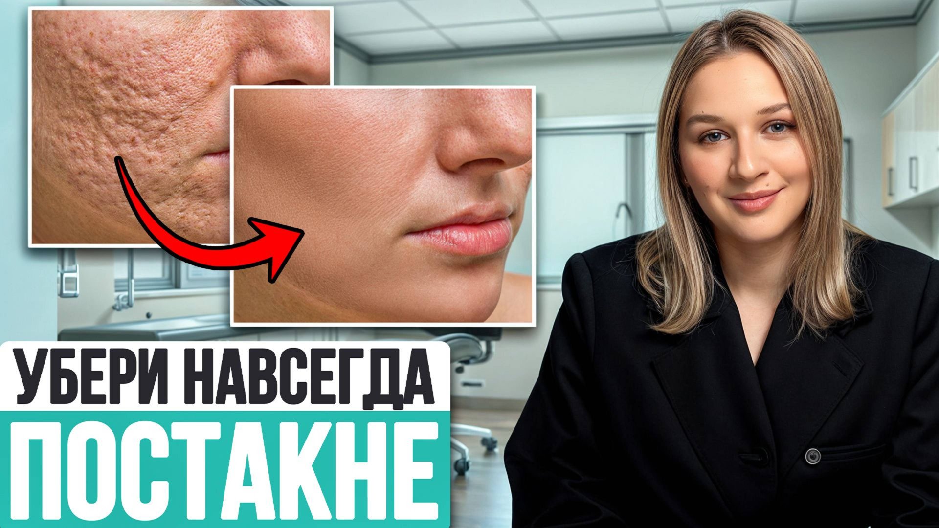 ТОП процедура от рубцов и шрамов! / Почему постакне не уходит? смотреть онлайн