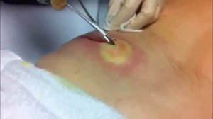 Pimple popping | Cyst popping | Гигантский прыщ на спине / Giant Acne on Your Back - Pus Extraction