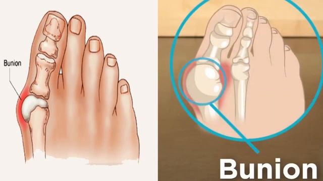 What is a Bunion or Hallux Valgus? смотреть онлайн
