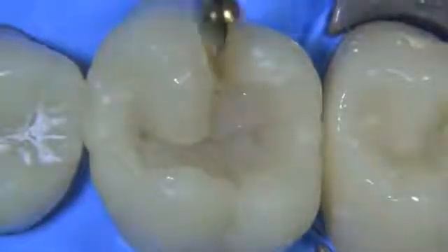Composite filling, Dr Prabhuraj sabarad, BDS, MDS смотреть онлайн