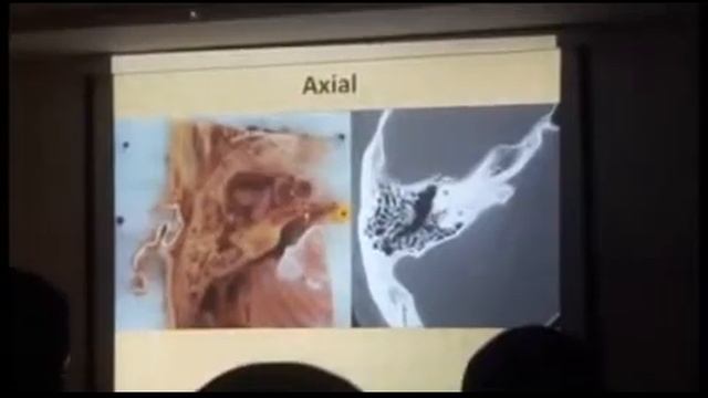 HRCT temporal bone [ Lecture -1 ] [ Complete lecture ] - Dr. Manoj Agarwal смотреть онлайн