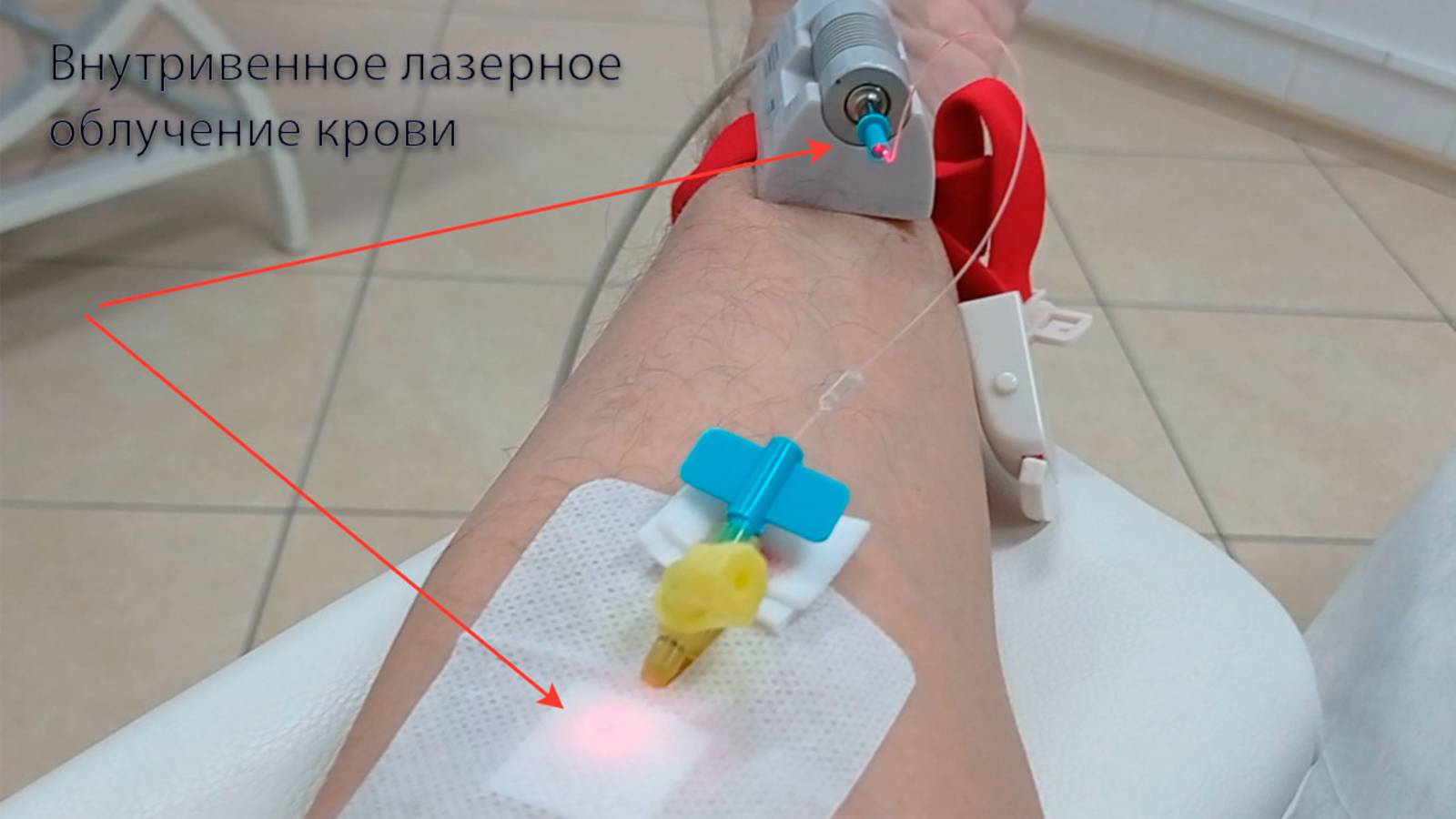 Внутривенное лазерное облучение крови