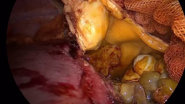 Hydatid cysts of the liver. Metin Ertem MD,FACS смотреть онлайн