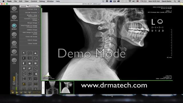 Setting Scale for AOMSI DRMA Digital X-ray Analysis смотреть онлайн