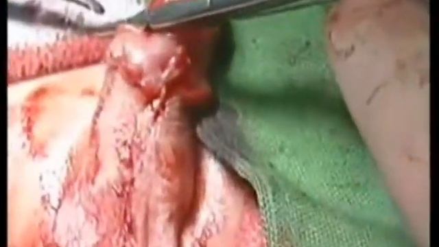 penile reconstruction repair of small penis p2 смотреть онлайн