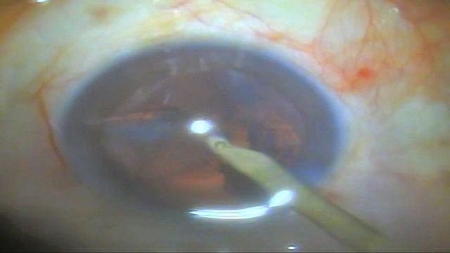 IOL Eversion during Phacoemulsification смотреть онлайн