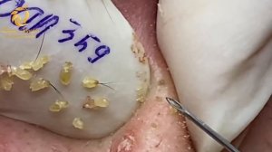 Treatment of acne tablets, pustules and blackheads (359) | Loan Nguyen