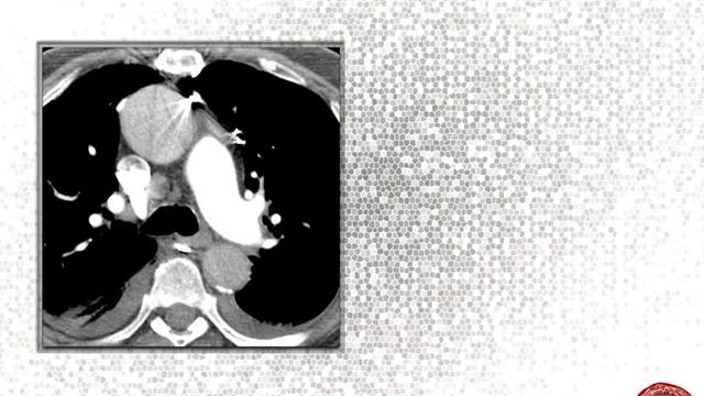 Acute Aortic Syndromes смотреть онлайн