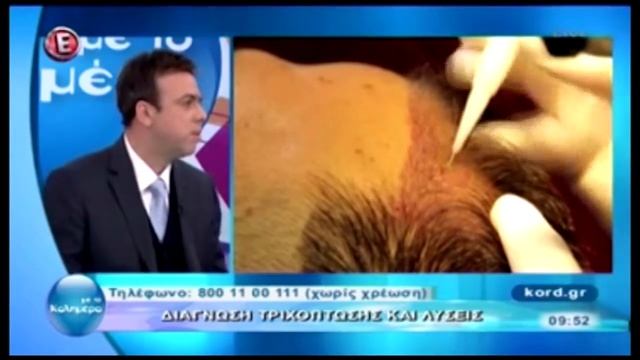 Συνέντευξη κ. Βαρδή Κορδερά - EPSILON TV - 16/03/2016 | Bergmann Kord - Μεταμόσχευση Μαλλιών FUE смотреть онлайн