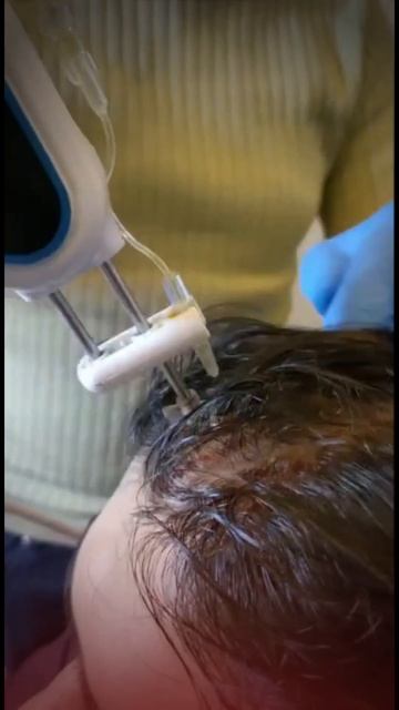 Hair PRP Treatment by Jj Aesthetics I Hair Growth with PRP I Hair Fall Treatment Rawalpindi. смотреть онлайн