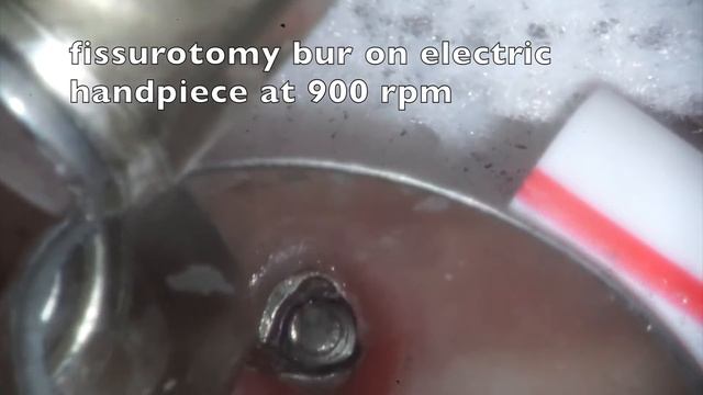 Broken Implant Screw Removal смотреть онлайн