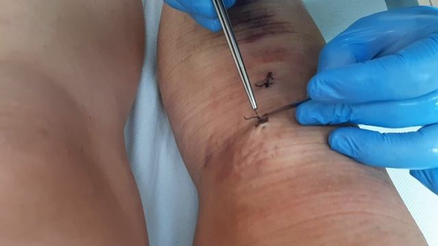 10 дней #ПослеОперации. Снятие швов. Пластика ПКС смотреть онлайн