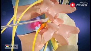 Иглонож при грыже в поясничном отделе позвоночника. Китайская медицина. Иглоукалывание