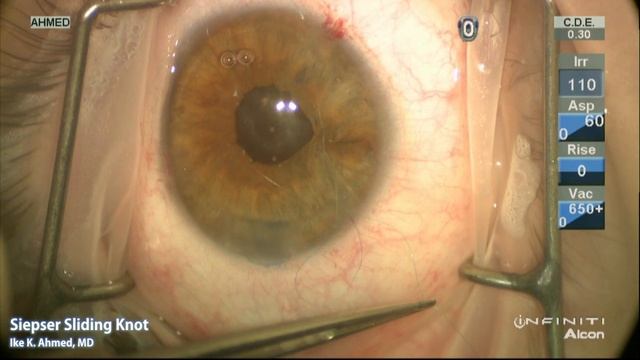 Modified Seipser Sliding Knot for Iris Suturing Ike Ahmed смотреть онлайн
