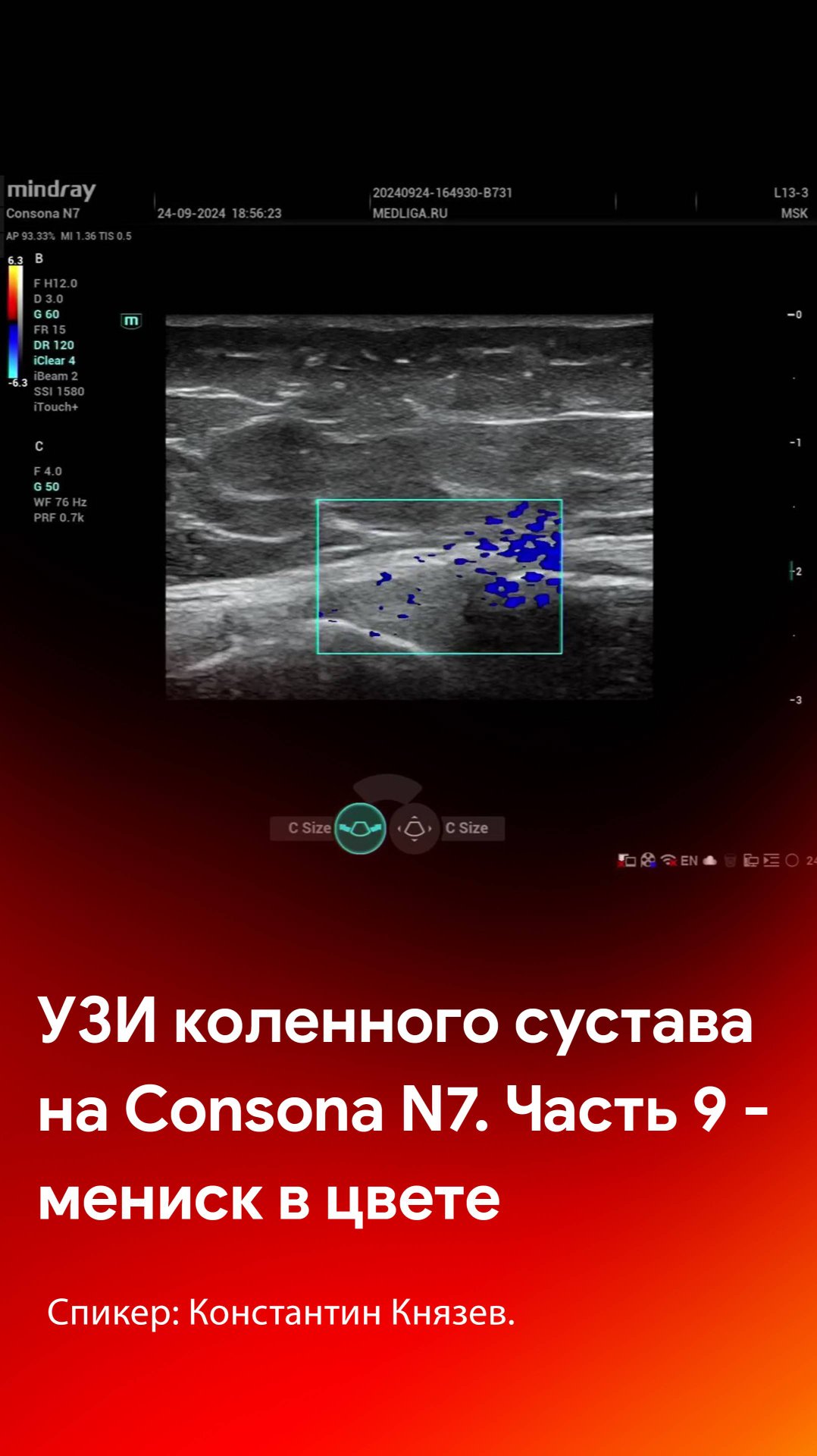 УЗИ коленного сустава на Mindray Consona N7. Часть 9 - мениск в цветовом допплере смотреть онлайн