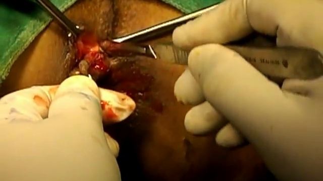 anal fistulae смотреть онлайн