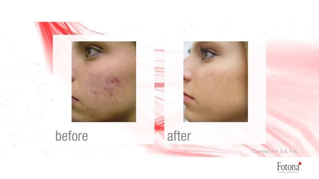 Fotona Laser Acne Treatment | Physimed Medispa смотреть онлайн
