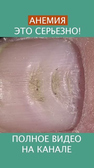 ТРЕВОЖНЫЕ ЗНАКИ АНЕМИИ - основные симптомы анемии! #shorts #анемия #гемоглобин #ферритин смотреть онлайн