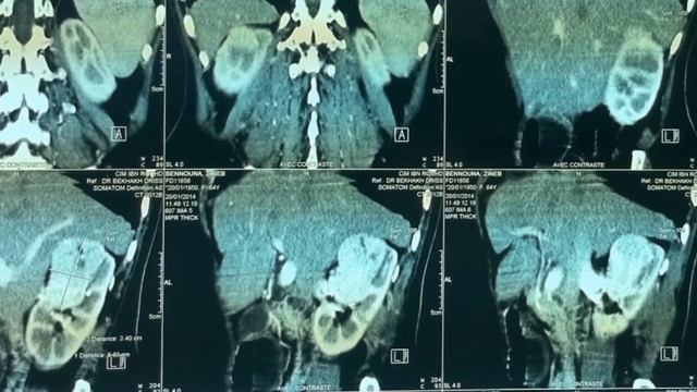 Endophytic right renal tumor with hilar development is nephron-sparing surgery legitimate? смотреть онлайн