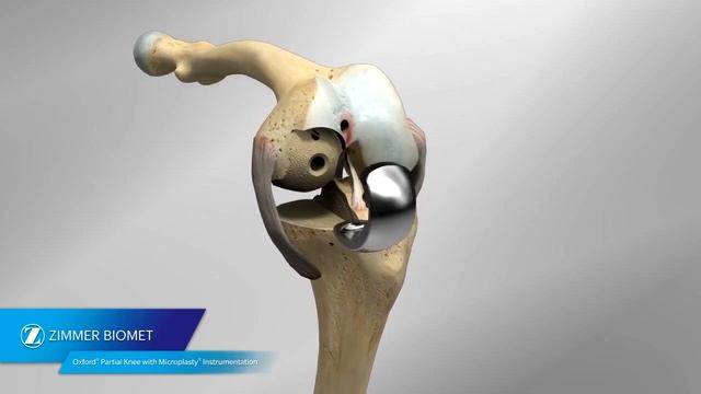 Oxford® Partial Knee Microplasty® Instrumentation Animation