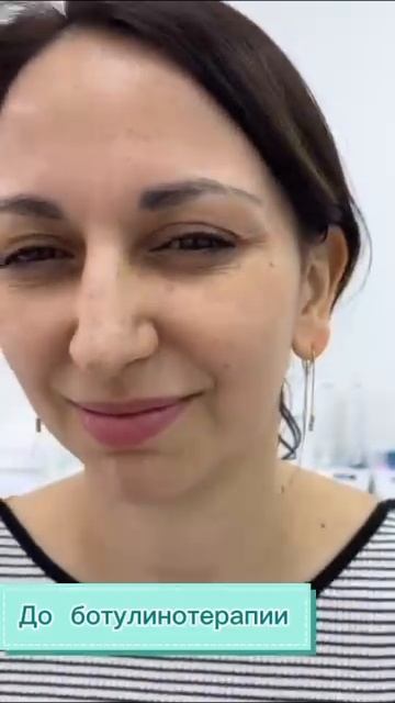 Эффект от ботокса #лазернаяэпиляция #депиляция #электроэпиляция #косметология смотреть онлайн