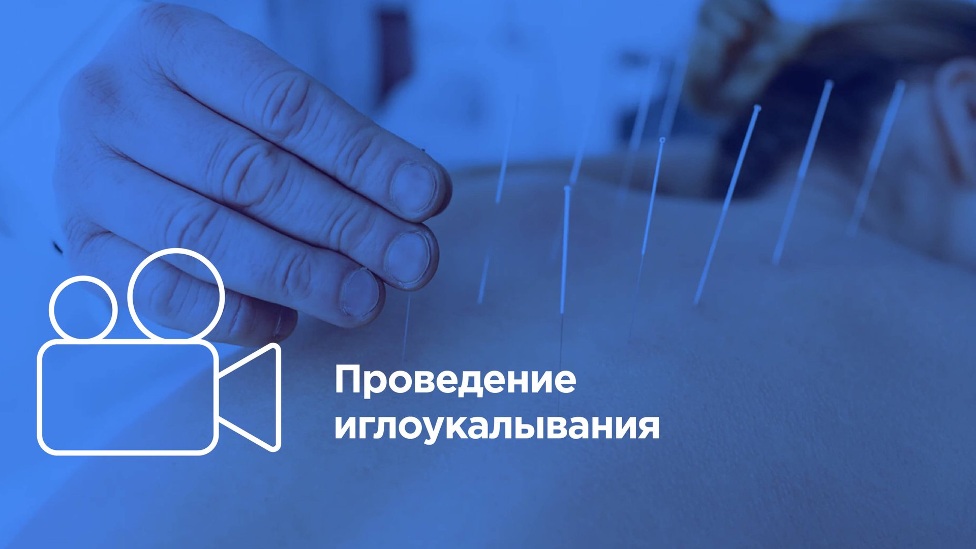 Проведение иглорефлексотерапии