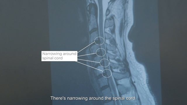 Spinal Stenosis patient story | ACDF | Dr. Michael Labagnara смотреть онлайн