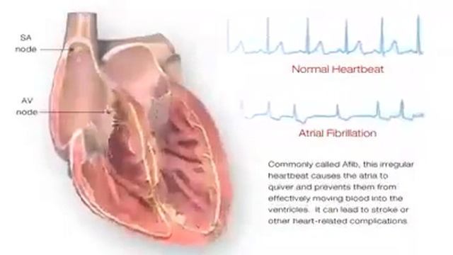 Atrial fibrillation смотреть онлайн