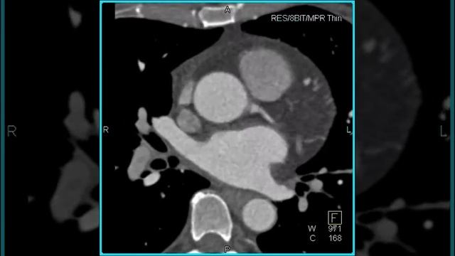 Cardiac: Normal aortic root (1 of 3) смотреть онлайн