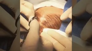 Удаление атеромы на голове