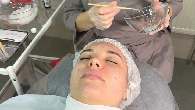 Чистка лица линейкой PHILOSOPHY ACNE смотреть онлайн