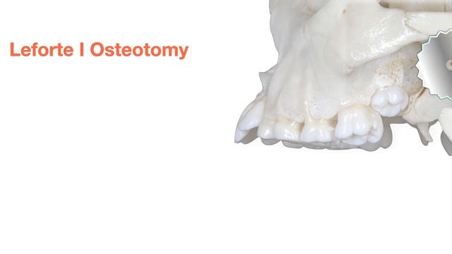 Infra-Zygomatic Crest Miniscrews｜【Chris Chang Ortho】CC569 смотреть онлайн