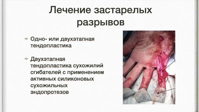 28. Повреждения сухожилий сгибателей и разгибателей пальцев кисти: диагностика,принципы лечения.