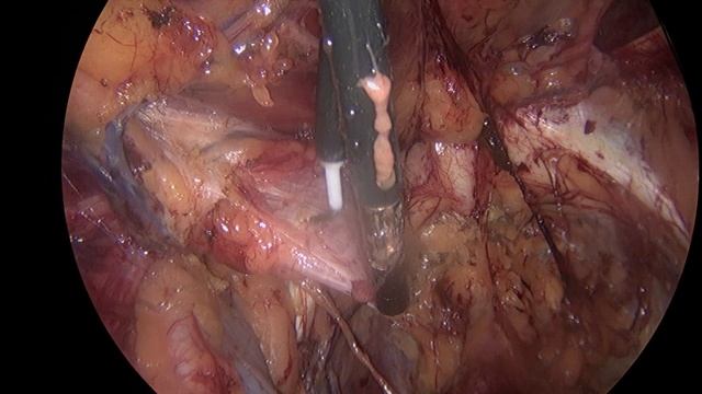 Диагностическая лапароскопия и ТЕР + смотреть онлайн