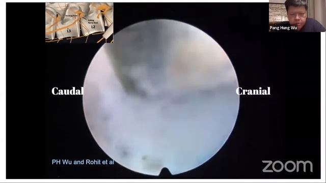 WFNS Spine Committee - How I Do It (Endoscopic Lumbar Spine Surgery) смотреть онлайн