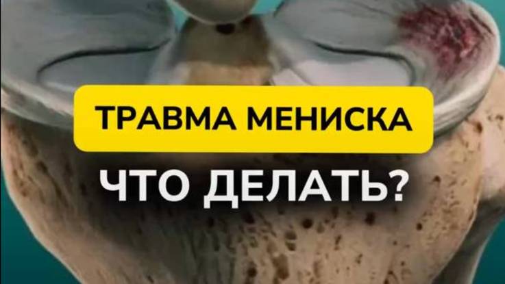 ТРАВМА МЕНИСКА. ЧТО ДЕЛАТЬ? смотреть онлайн