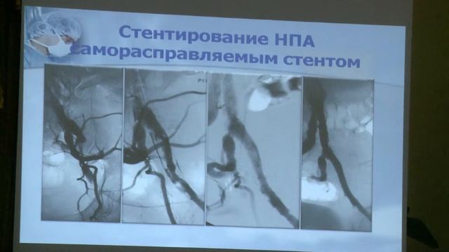 Мультидисциплінарний підхід до лікування критичної ішемії нижніх кінцівок у хворих з синдромом д.ст смотреть онлайн