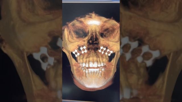 4 Titanium Square 3 Dimensional plates with 16 Screws - Gummy Smile Correction смотреть онлайн