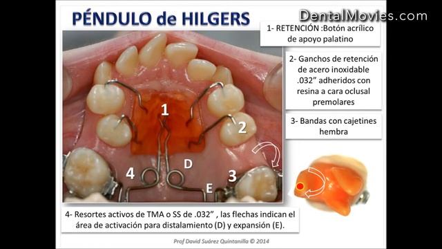 Ортодонтический аппарат Pendulum