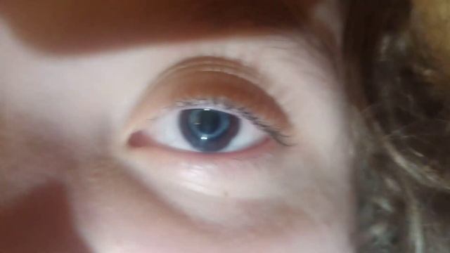My iris glowing due to lens implant смотреть онлайн