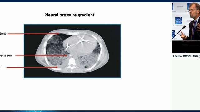 How to guide treatment with transpulmonary pressure Laurent Brochard 2018
