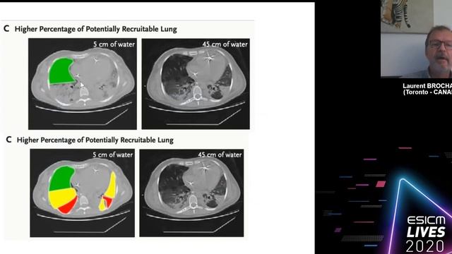Assessing recruitment at the bedside Laurent Brochard 2020