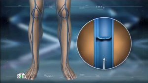 Медицинские микросферы в новостях