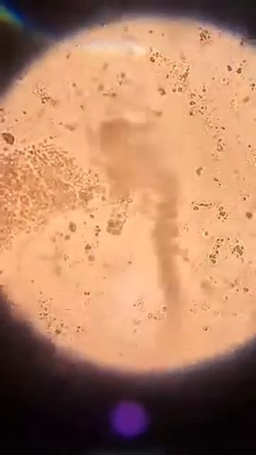 Strongyloides stercoralis larva in Stool Sample (HPO) | Clinical Parasitology смотреть онлайн